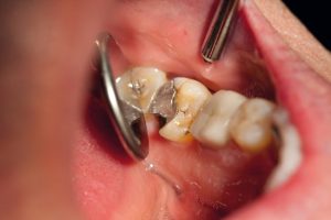 amalgammes dentaires et maladie de lyme 