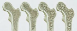 Osteoporose
