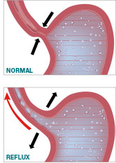 Schéma d'un reflux et du fonctionnement normal