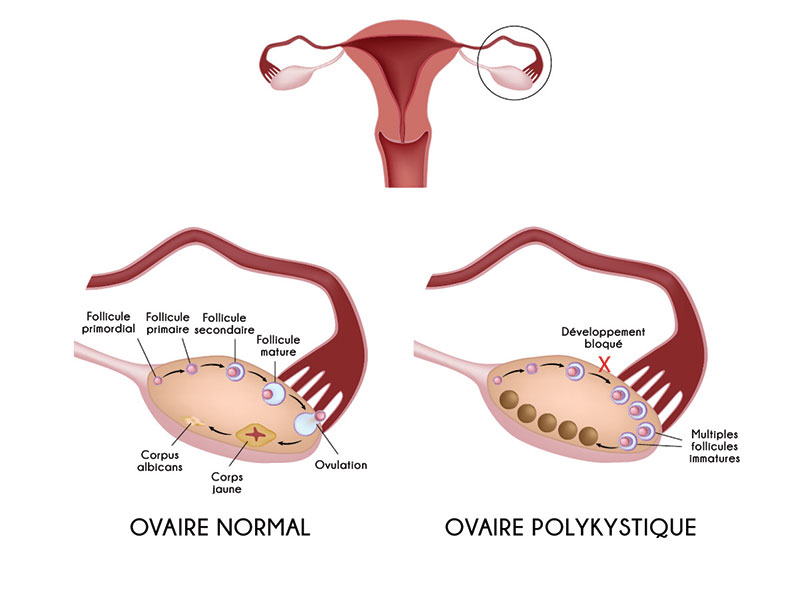 Accompagner le SOPK avec des moyens naturels - Bio Infos Santé