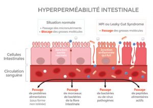 sSchéma sur l'hyperméabilité intestinale en situation normale et HPI ou Leaky Gut Syndrome